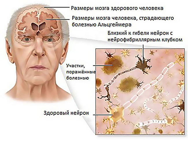 Хвороба Альцгеймера, тривалість життя, поради по догляду за хворим