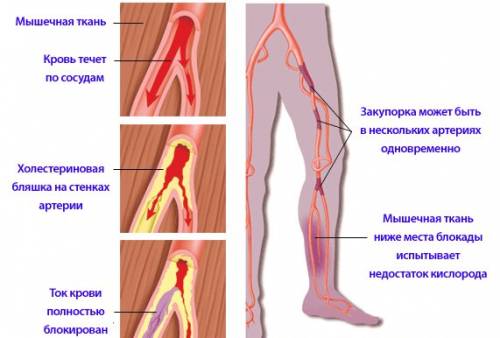 Консервативне лікування облітеруючого атеросклерозу