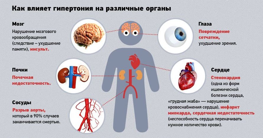 Гіпертонія другого ступеня симптоми