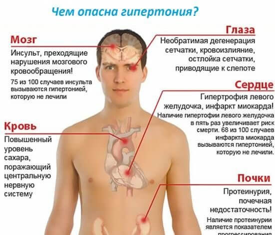 Гіпертонія другого ступеня симптоми