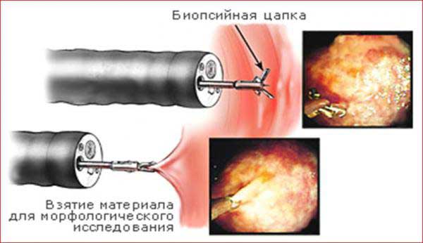 Уртикарний васкуліт