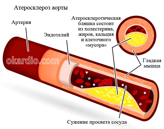 Початкові ознаки атеросклерозу аорти