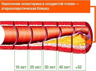 Атеросклероз хронічний