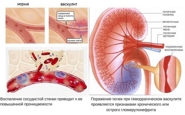 Анця васкуліти